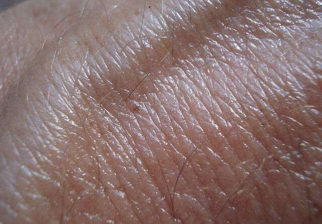 Sunburn: Skin Cancer and Aging of the Skin