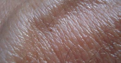 Sunburn: Skin Cancer and Aging of the Skin