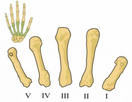 The ‘Silent’ Disease of Osteoporosis Affects 10 Million Americans